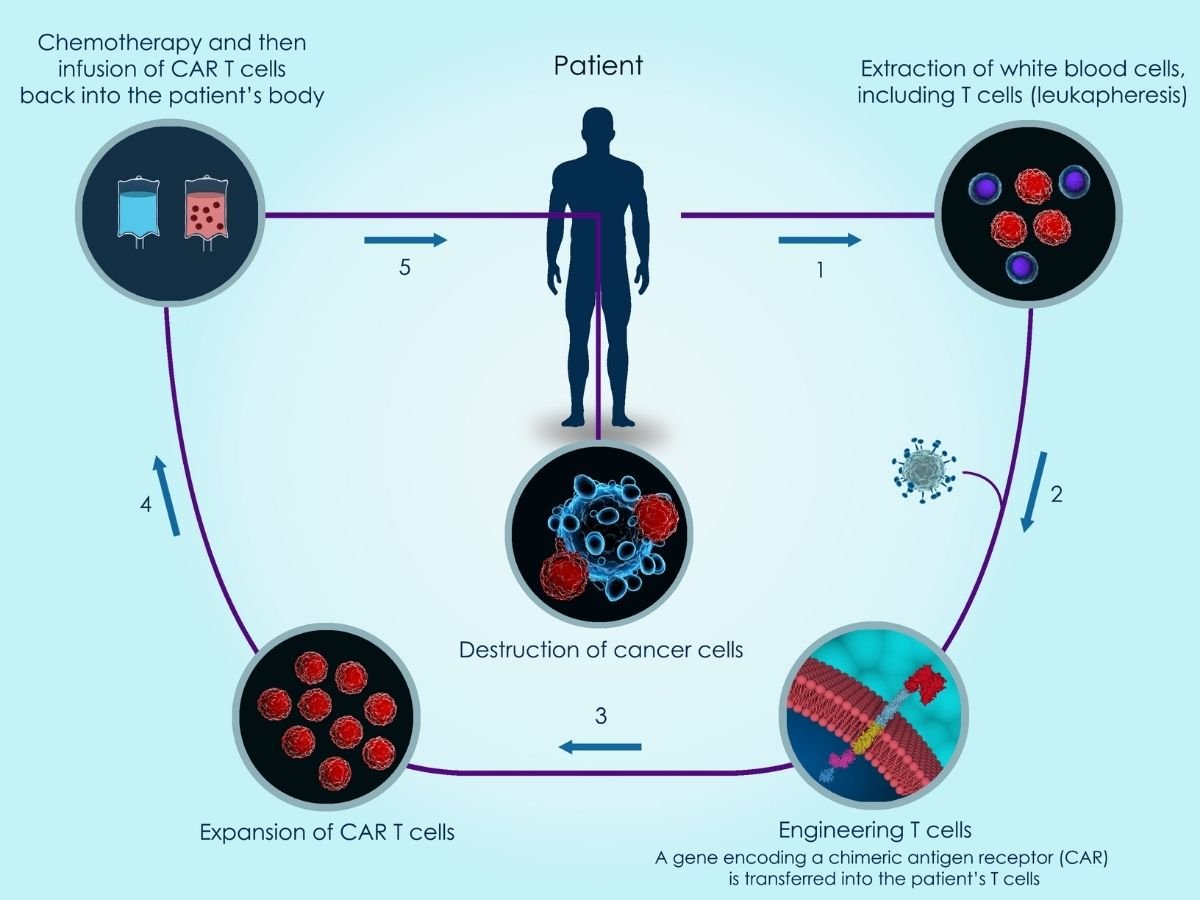    An illustration of how CAR-T cell therapy works.